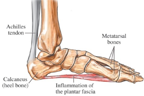 Plantar fasciitis